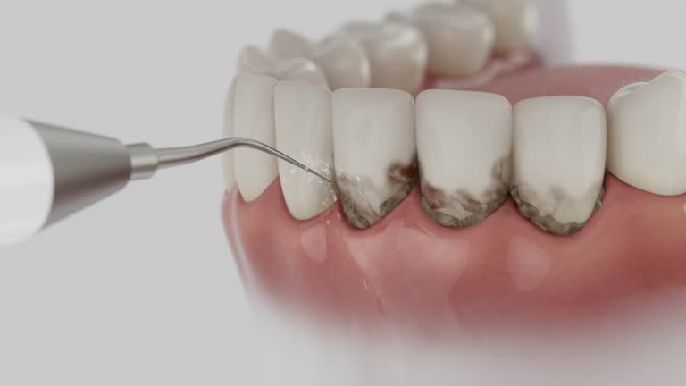 Trusted Wisdom Tooth Removal service in Springfield, OR - Dentist Open Now